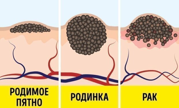 Диагностика и удаление родинок. Профилактика рака кожи. О сложной проблеме простыми словами.