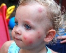 Як захистити дитину від укусів комарів