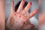 В Україні зафіксовано випадки інфекційного захворювання: хто у групі ризику