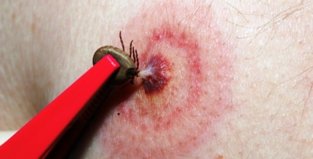 Хворобу Лайма хочуть лікувати по-новому