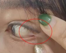 Око жінки пришили до повіки