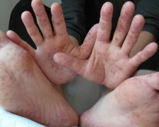 Корь в школах: родителей заставят платить за больного ребенка