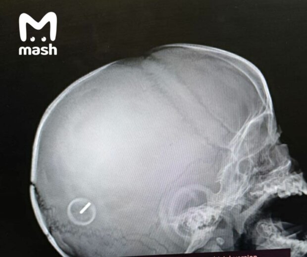 Рентген постраждалої дитини, фото: Mash