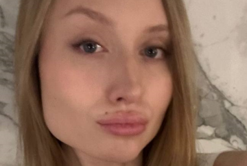 Девушка с неудачными "уколами красоты", фото из соцсетей