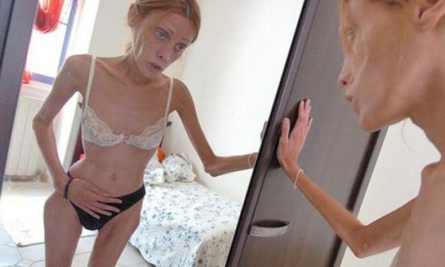 Медики назвали истинную природу анорексии