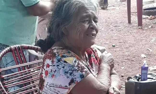 81-летняя жительница Бразилии, 56 лет носившая окаменевший плод