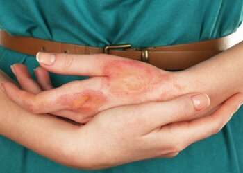 Ожог. Фото Центр семейной медицины