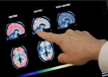 Сканування мозку пацієнтів із деменцією та без неї, фото: Matt York/AP