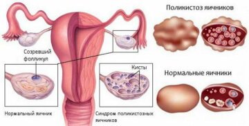 Затримка місячних