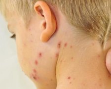 Кір скосив українців: МОЗ озвучив шокуючі цифри