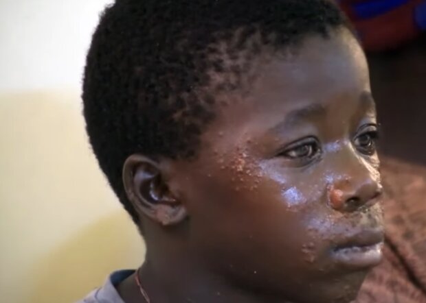 У Сенегалі стався спалах невідомої хвороби, фото: кадр з відео