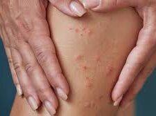 Укус комахи. Фото Українська правда