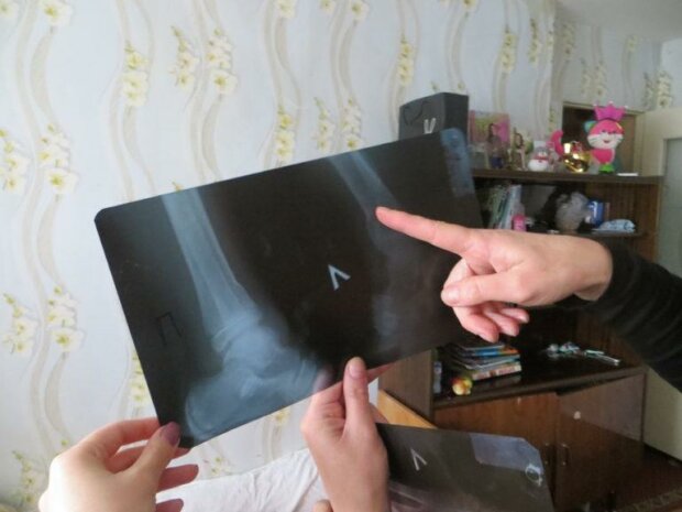 В Запорожье подросток вспомнил детство и сломал обе ноги - нужна срочная операция