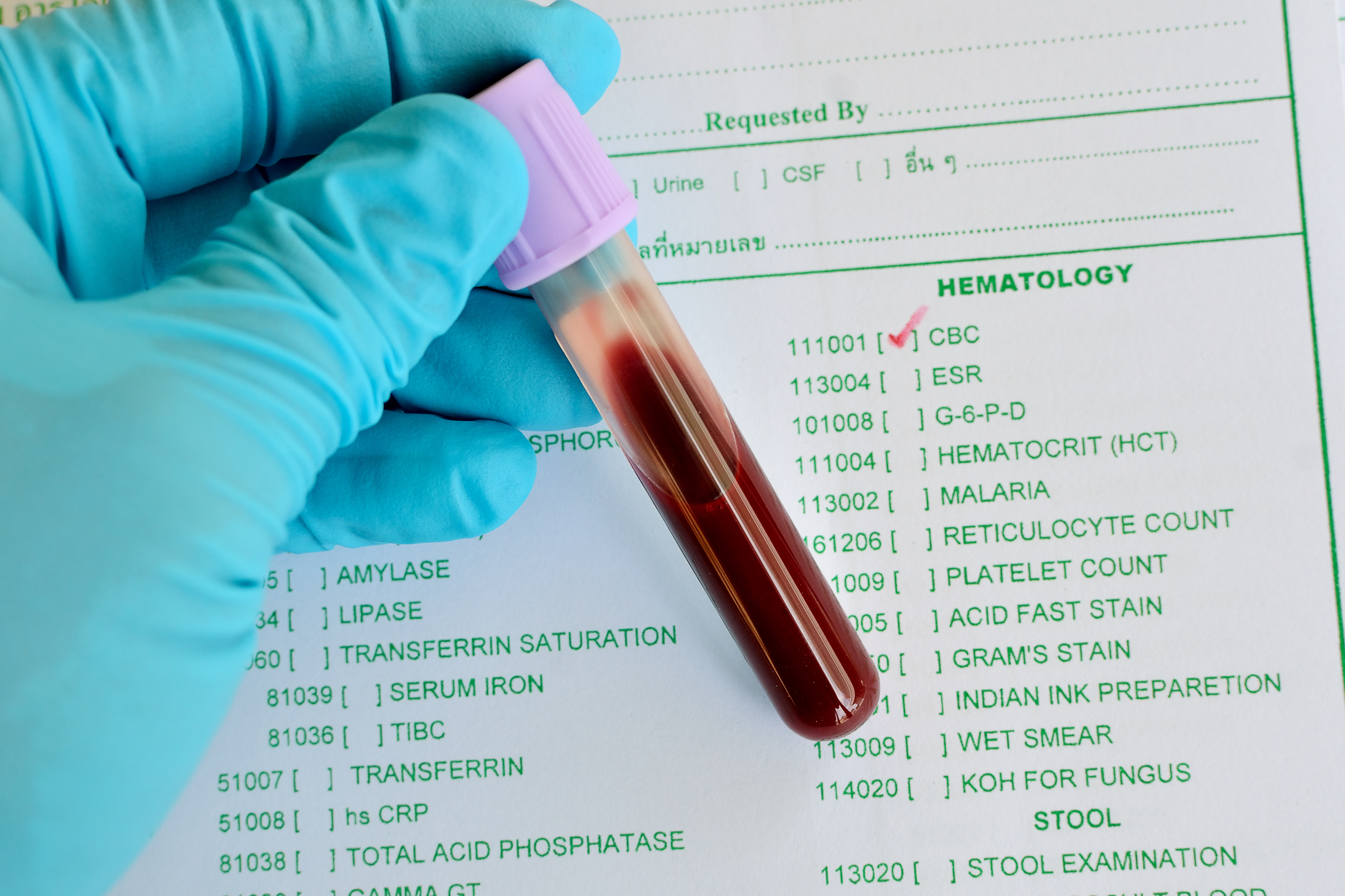Тест биохимический анализ крови. Анализ крови. Исследование общего анализа крови. Общий клинический анализ. Общеклинические исследования крови.